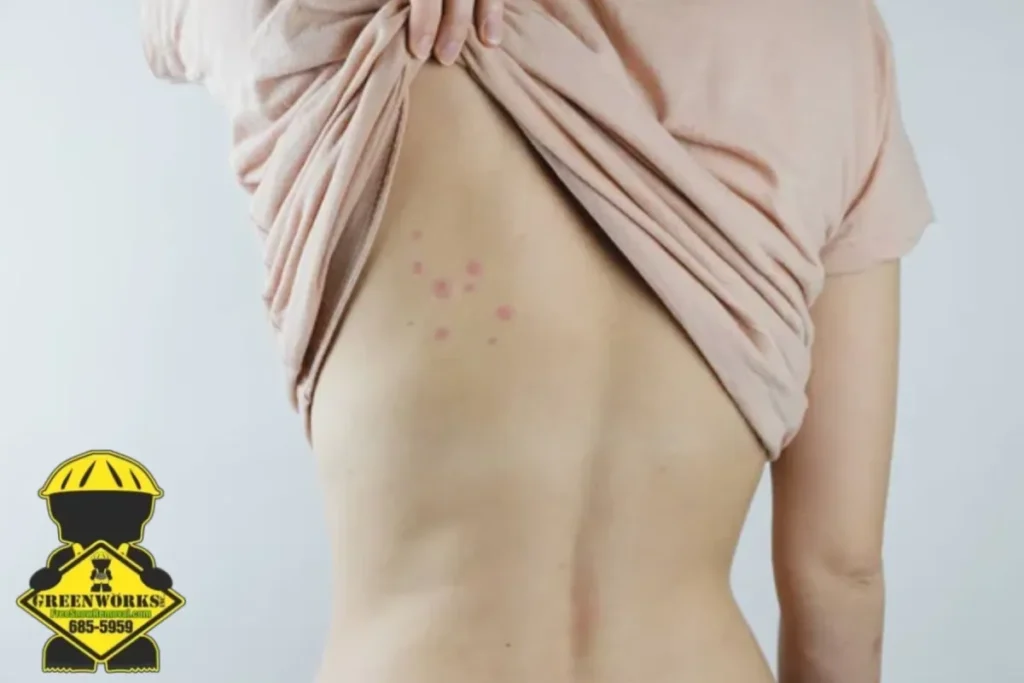 bed bug bites